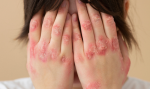 Bệnh tay chân miệng ở trẻ em