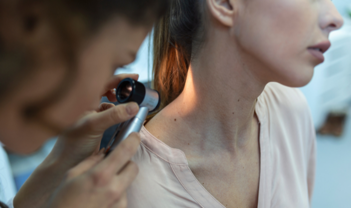 Tẩy nốt ruồi TikTok là gì?