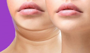 Hút mỡ nọng cằm là gì?