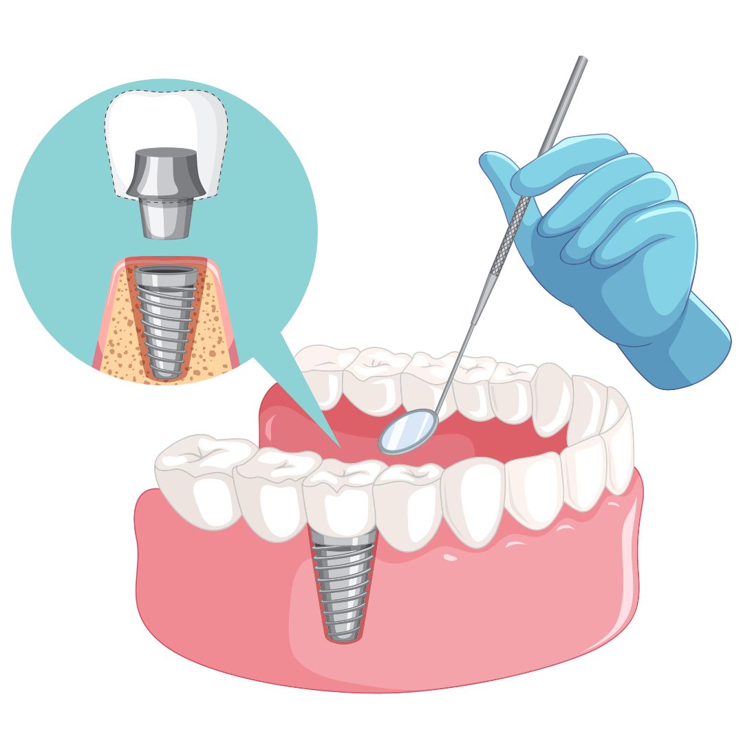 Lợi ích khi chọn sp79 cho cấy implant