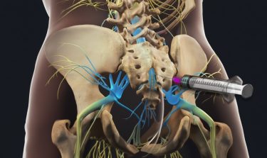 Tiêm ngoài màng cứng: Giải pháp cho đau thần kinh tọa hiệu quả