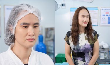 Nên cắt mí hay nâng cung mày khi bị sụp mí?