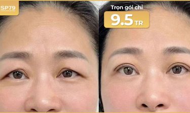 Nâng cung mày có an toàn không? Ưu đãi trọn gói chỉ 9.5 triệu tại SP79