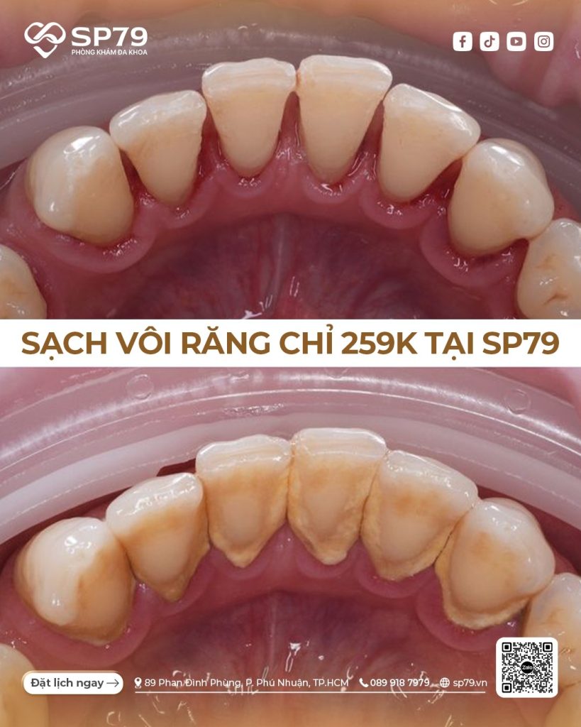 cạo vôi răng giá rẻ 259k sp79