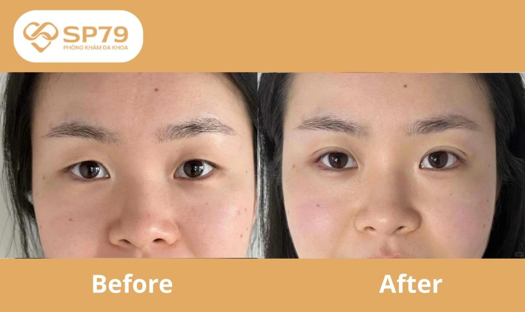 Kết quả nhấn mí khác biệt tại SP79