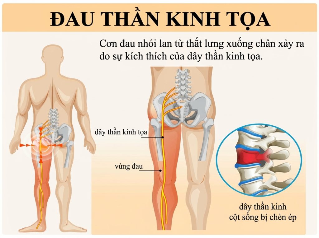Hội chứng đau thần kinh tọa là gì? Nguyên nhân do đâu?